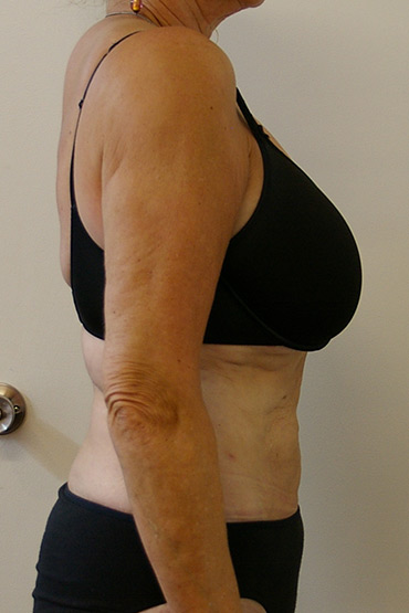Abdomen | Liposuction Australia
