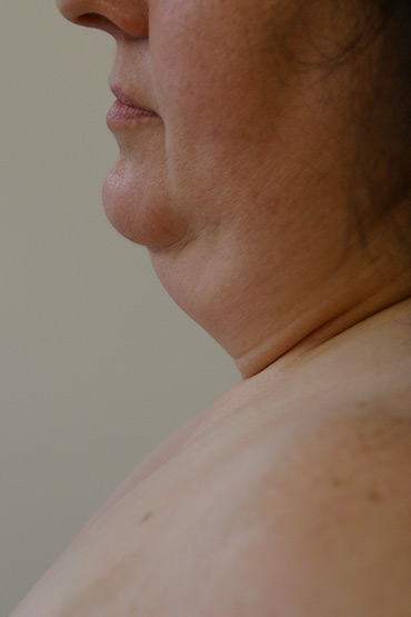Neck / Chin | Liposuction Australia