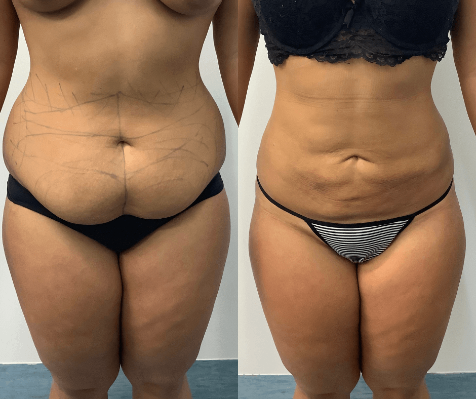 female stomach liposuction results
