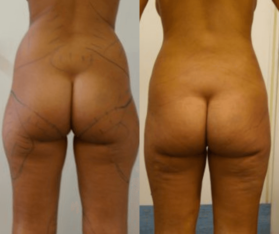 female thigh liposcution results