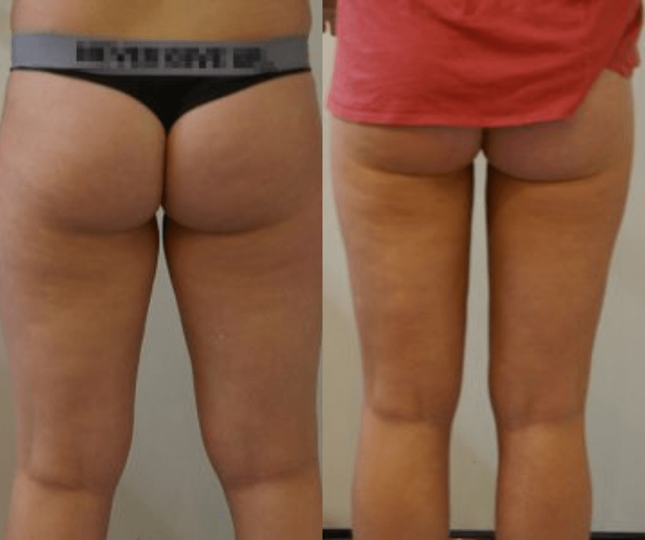 female thigh liposcution results