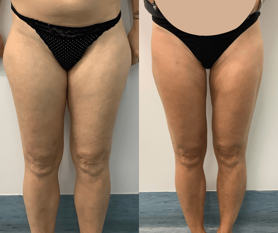 women thighs