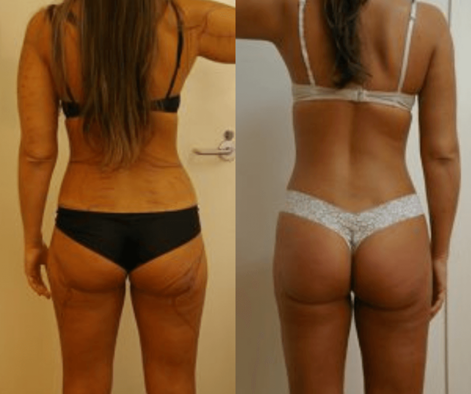 Liposuction of the Love Handles or Flanks Reduce Sides, Love Handles and Flanks with Liposuction