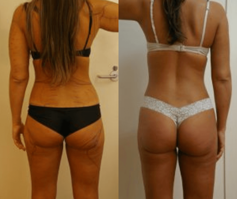 Breast Reduction Liposuction