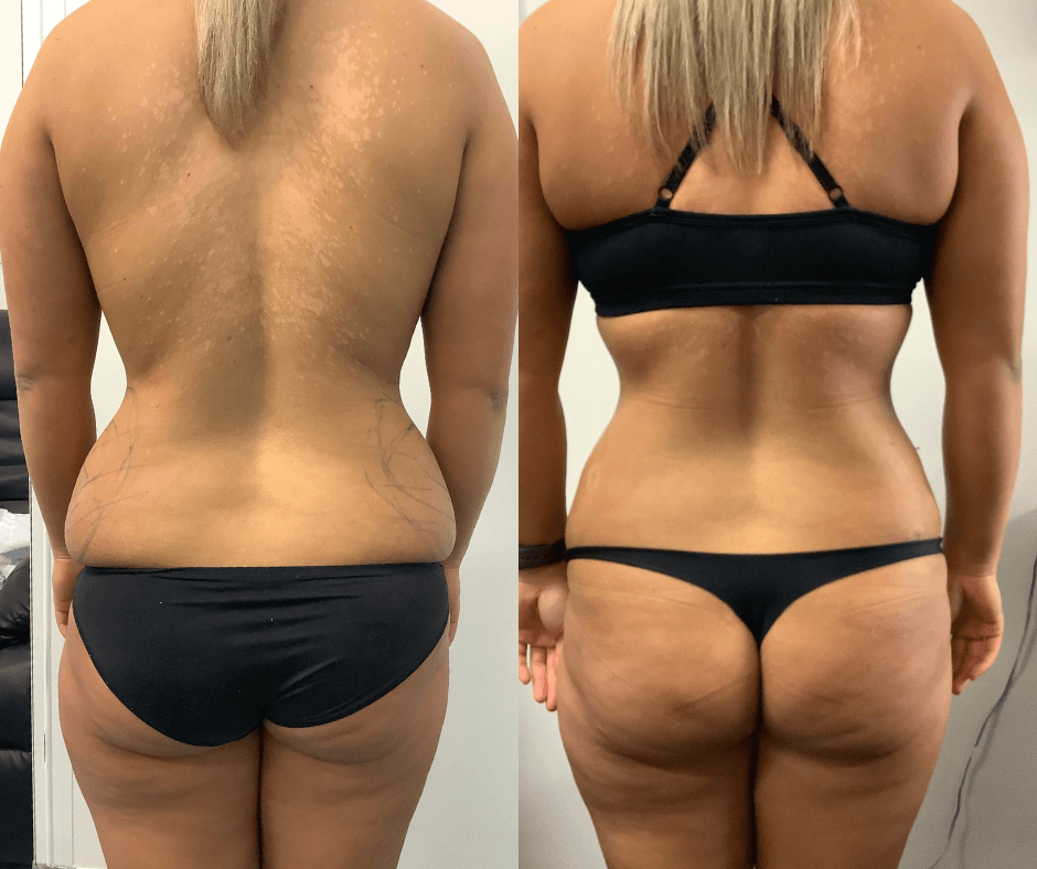 38 F After Liposuction Neck and Back