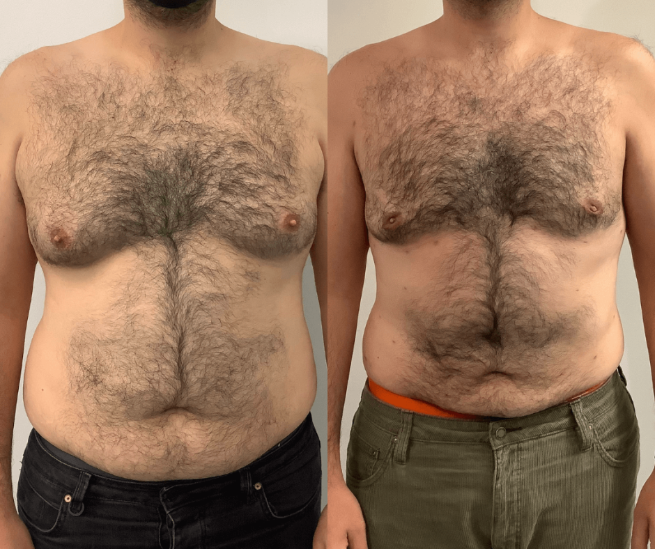 Liposuction to love handles: good results vs great results