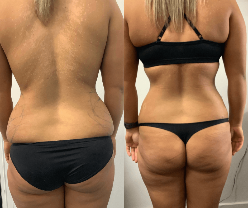 Mons Pubis - Liposuction Australia