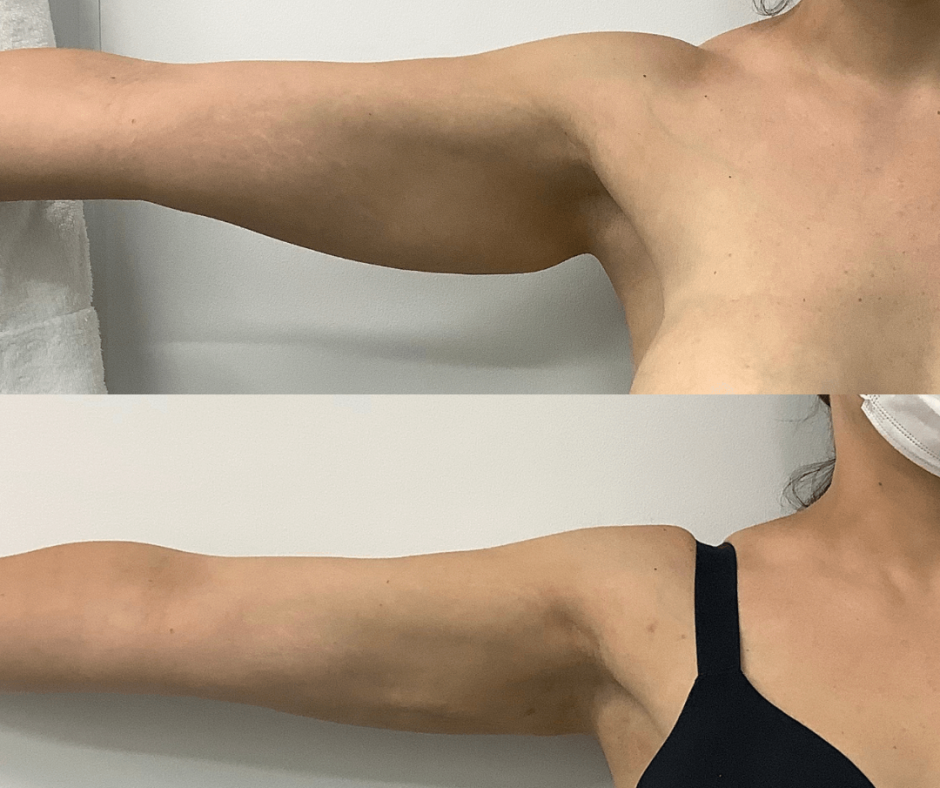 Armpit Fat Removal In Melbourne