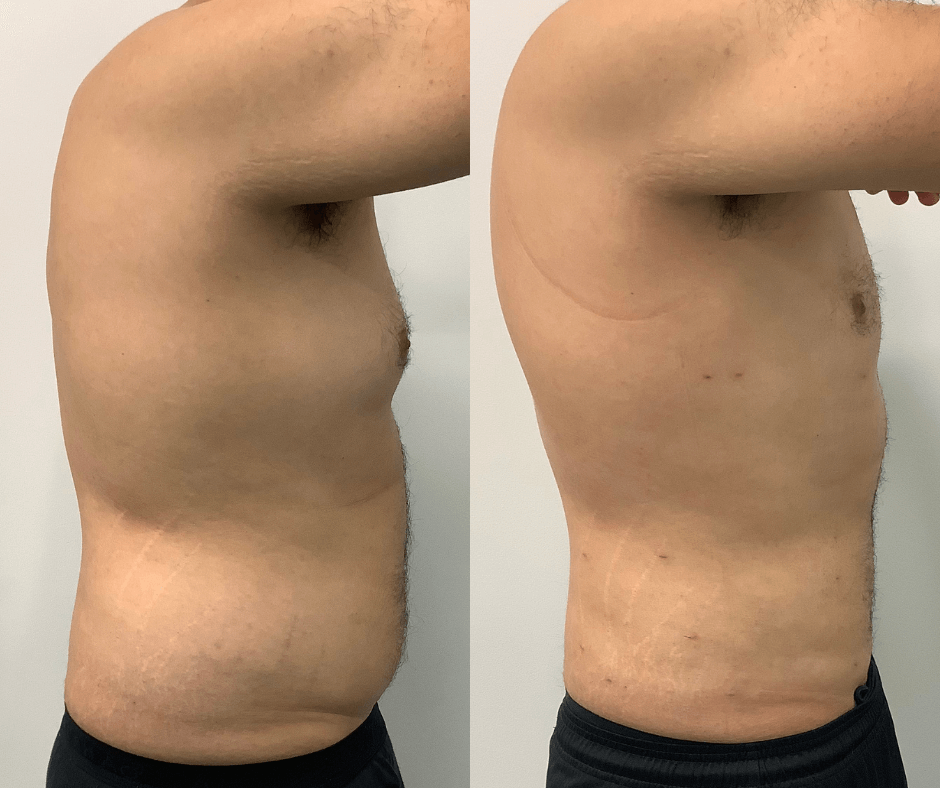 male before and after liposcution