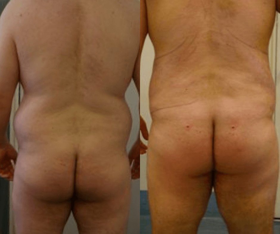 male back liposuction resultrs