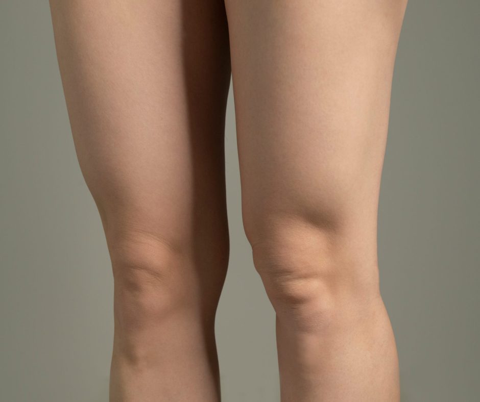 Fat,Folds,Above,Knees.,Woman`s,Hips,Closeup,Raw,Studio,Shot
