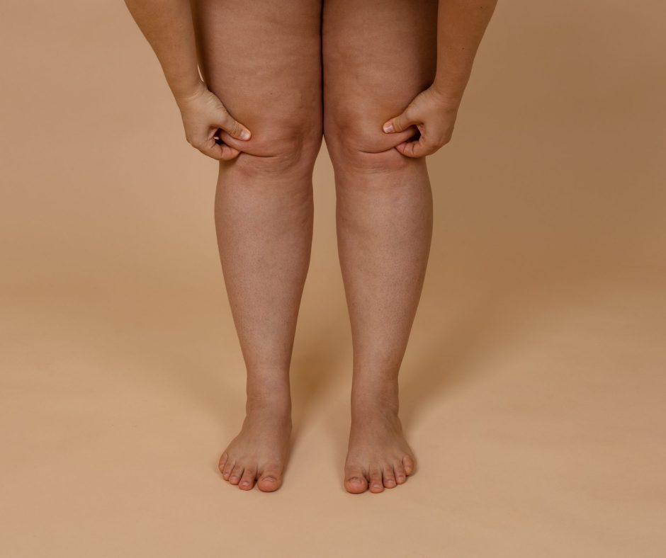 Cropped,Photo,Of,Woman,Bare,Naked,Legs,,Pinching,Fat,On
