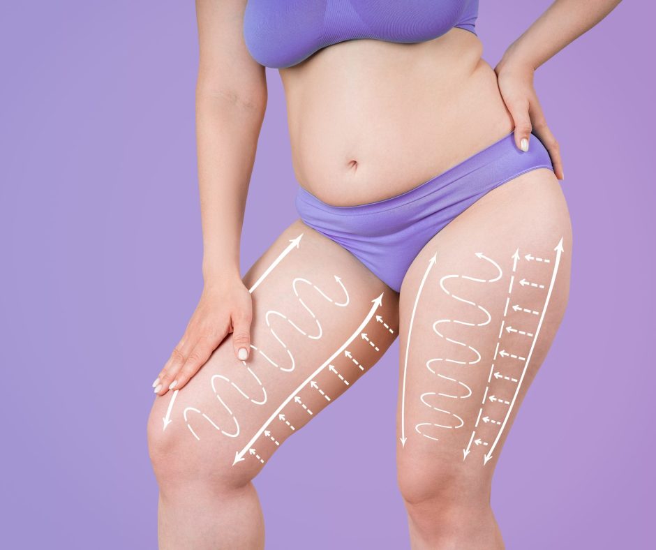Legs,And,Buttocks,Liposuction,,Fat,And,Cellulite,Removal,Concept,,Overweight