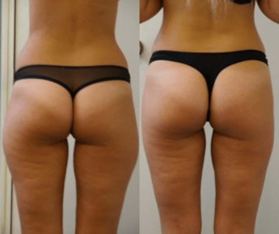female thigh liposcution results