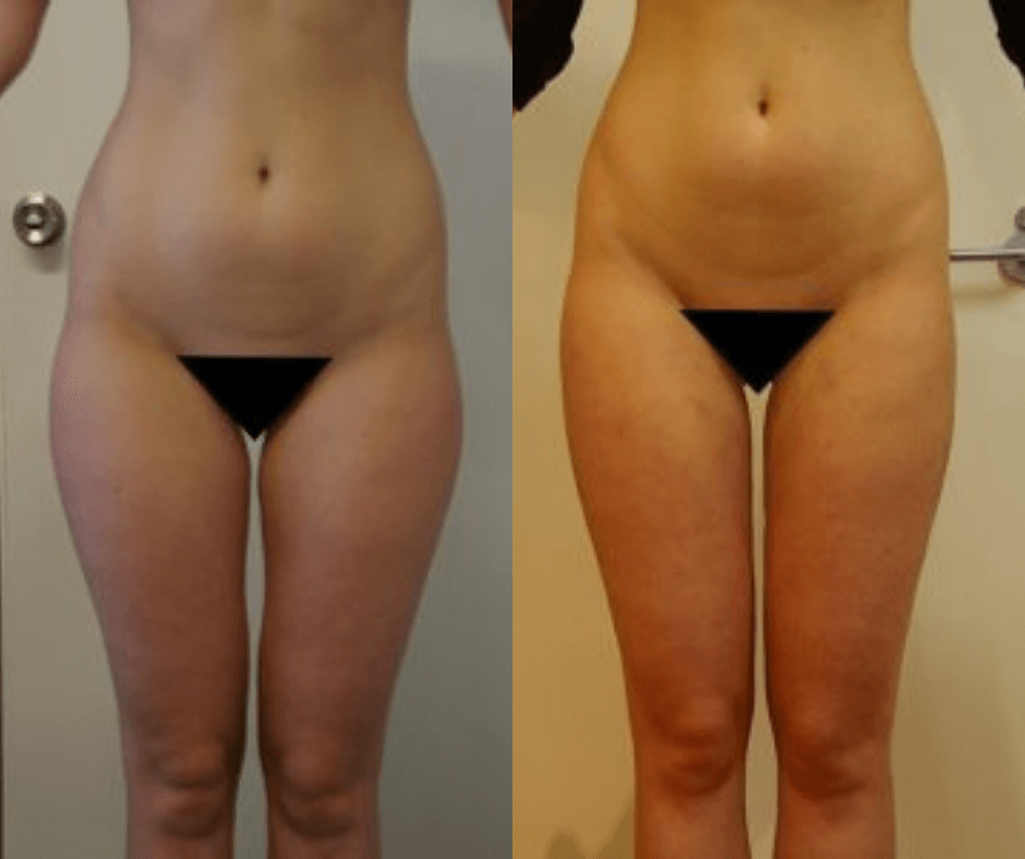 Mons Pubis - Liposuction Australia